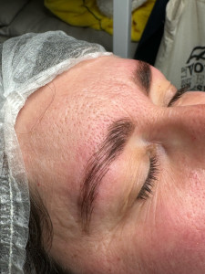 Photo de galerie - Browlift