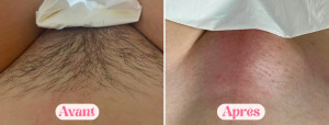 Photo de galerie - Epilation à la cire 