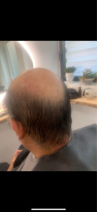 Photo de galerie - Avant la prothèse 