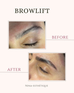 Photo de galerie - Browlift sourcils 