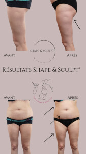 Photo de galerie - Résultat du soin en perte de centimètre 