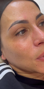 Photo de galerie - Soin Hydrafacial