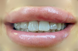 Photo de galerie - Strass dentaire