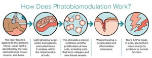 Photo de galerie - Photobiomodulation