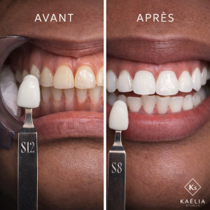 Photo de galerie - Blanchiment dentaire avant/après – résultat visible immédiatement ?