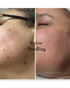Photo de galerie - Après 3 séances de Microneedling 