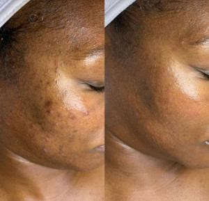 Photo de galerie - Problèmes de taches, mélasma, coups de soleil, brûlures chimiques