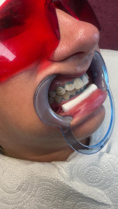 Photo de galerie - Strass dent