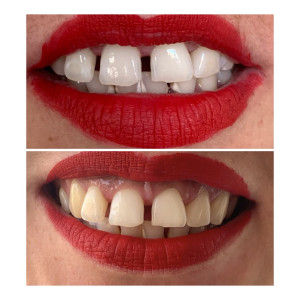 Photo de galerie - Blanchiment dentaire 