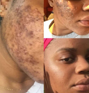 Photo de galerie - Problèmes d'acné, boutons, peau grasse