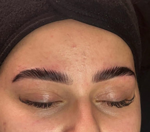 Photo de galerie - Résultat Brow lift